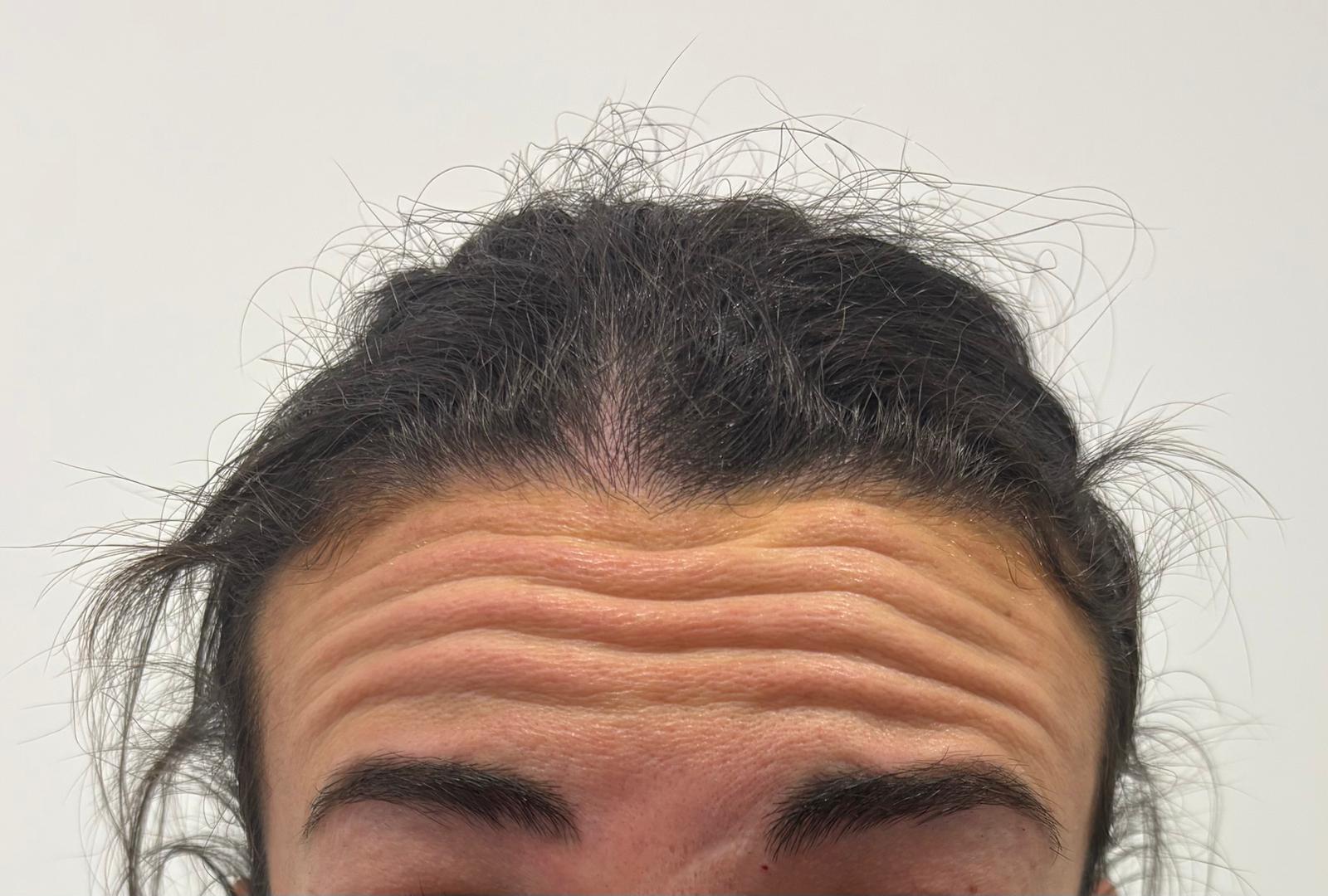 Antes