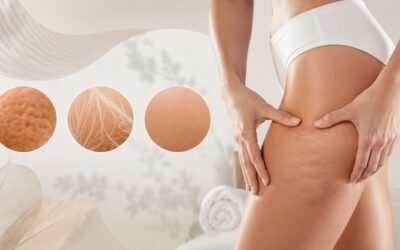 ¿Qué tratamiento es más adecuado para la celulitis, las estrías o las cicatrices?